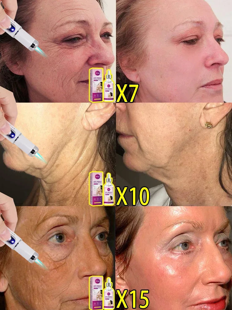 Laser wrinkle remover, wrinkle eraser laser pen, anti-aging laser device, anti-wrinkle serum, remove wrinkles fast, best laser for wrinkles, laser therapy for fine lines, home laser treatment for wrinkles, skin tightening laser, face lifting device, wrinkle reduction tool, anti-aging skincare, collagen booster, crow’s feet removal, forehead wrinkle remover, sagging skin treatment, smooth fine lines, non-invasive wrinkle solution, best home laser for anti-aging, skin rejuvenation laser, under-eye wrinkle tre